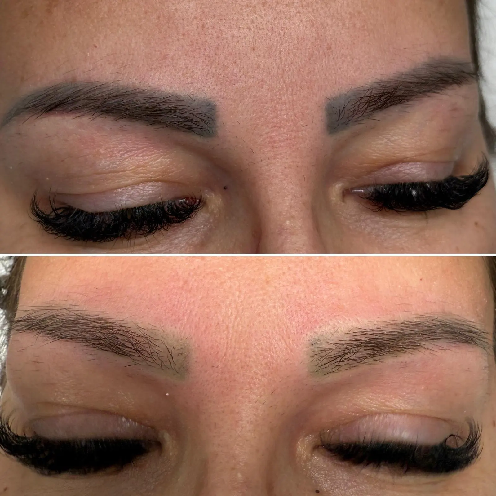 Îndepărtare Laser Tatuaj - Înainte și După 1