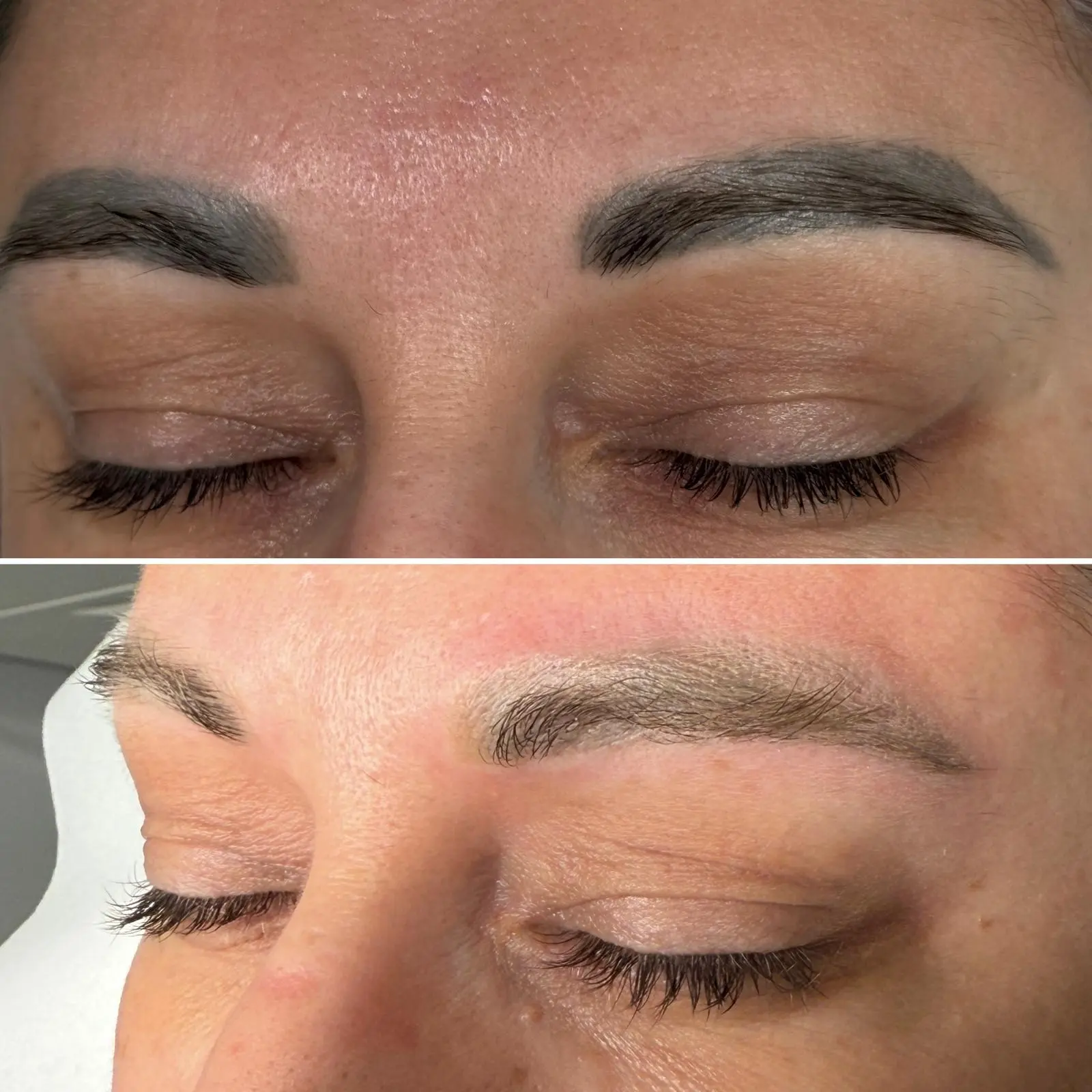 Îndepărtare Laser Tatuaj - Înainte și După 2