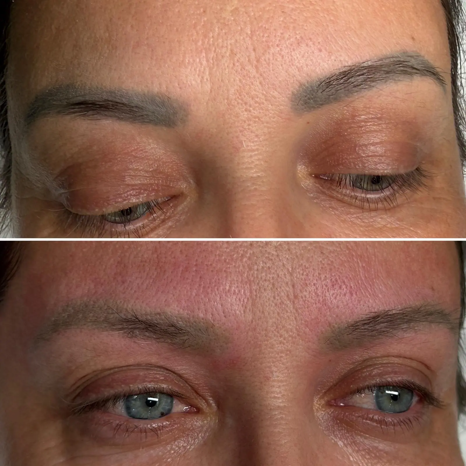 Îndepărtare Laser Tatuaj - Înainte și După 3